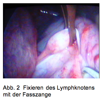 Fixieren des Lymphknotens mit der Fasszange.png